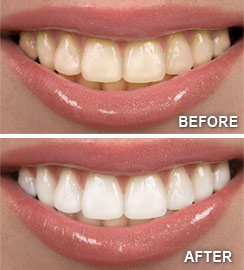 Indianapolis-teeth-whitening